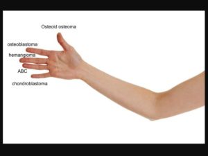 percutaneous ablation of benign bone tumors