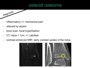 percutaneous ablation of benign bone tumors
