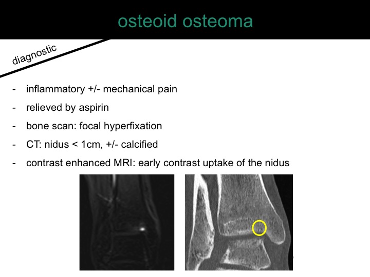 percutaneous ablation of benign bone tumors