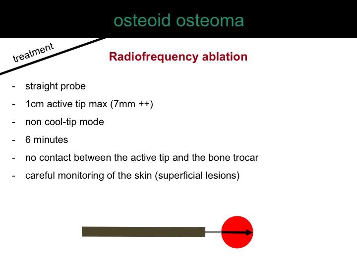 percutaneous ablation of benign bone tumors