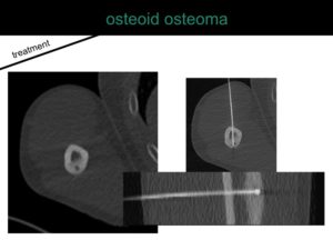 percutaneous ablation of benign bone tumors