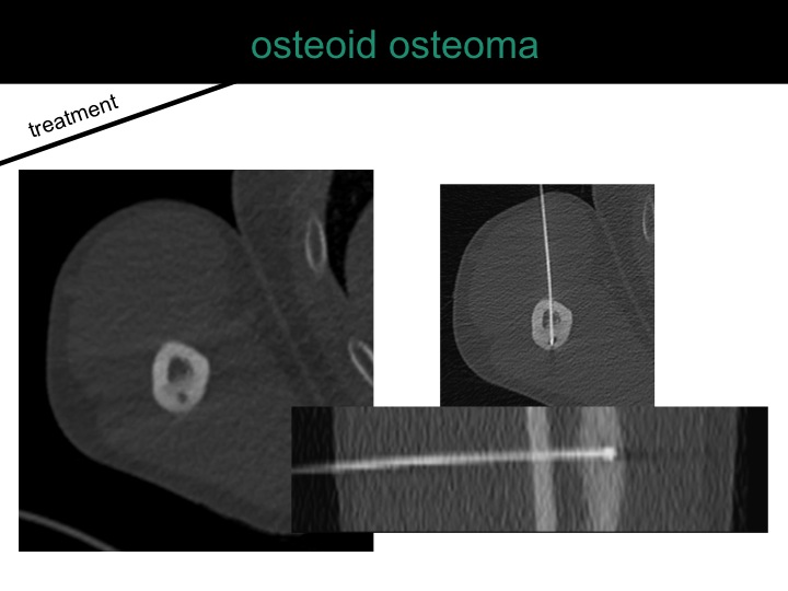 percutaneous ablation of benign bone tumors