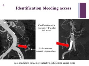 Vascular oncology emergencies managementHemorrhage in oncologic interventional radiology