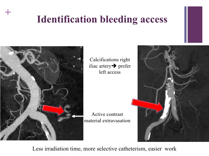 Vascular oncology emergencies managementHemorrhage in oncologic interventional radiology