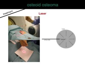 percutaneous ablation of benign bone tumors