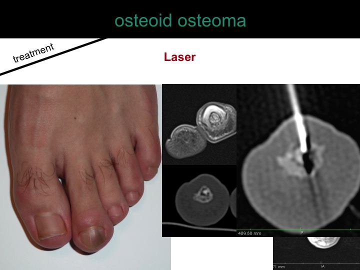 percutaneous ablation of benign bone tumors