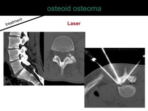 percutaneous ablation of benign bone tumors