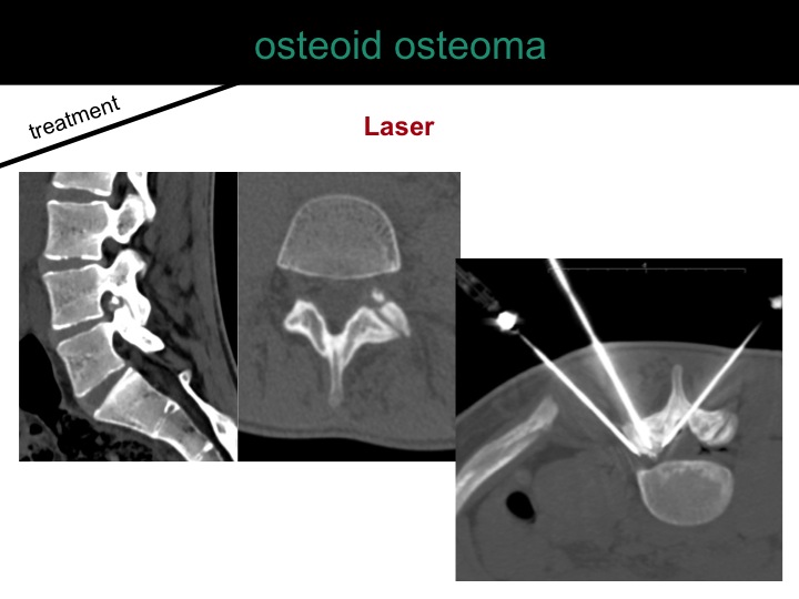 percutaneous ablation of benign bone tumors