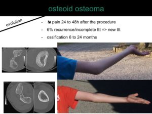 percutaneous ablation of benign bone tumors