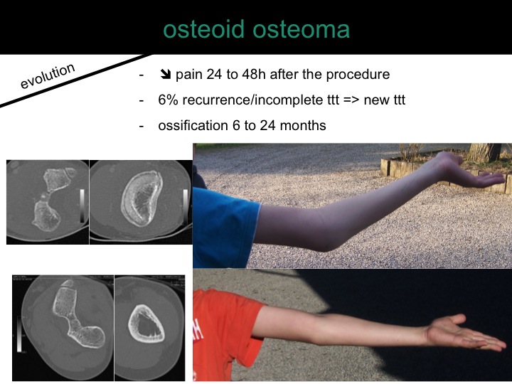 percutaneous ablation of benign bone tumors