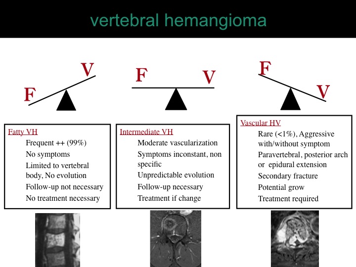 percutaneous ablation of benign bone tumors