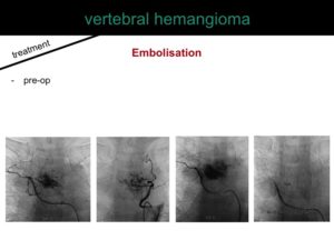 percutaneous ablation of benign bone tumors