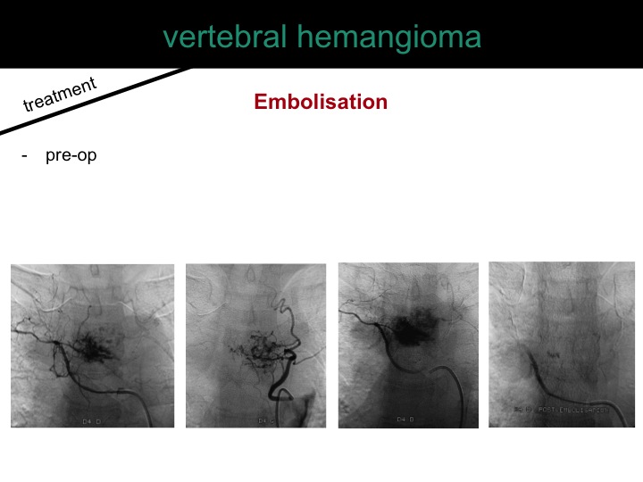 percutaneous ablation of benign bone tumors