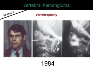 percutaneous ablation of benign bone tumors
