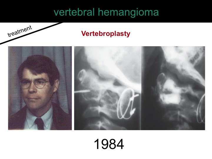 percutaneous ablation of benign bone tumors
