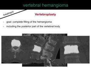 percutaneous ablation of benign bone tumors