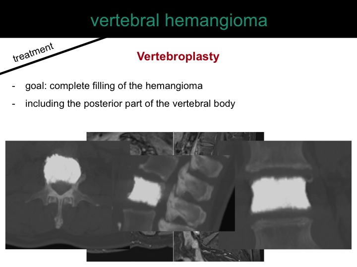 percutaneous ablation of benign bone tumors
