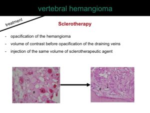 percutaneous ablation of benign bone tumors