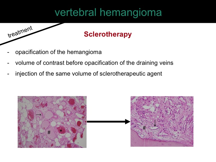 percutaneous ablation of benign bone tumors