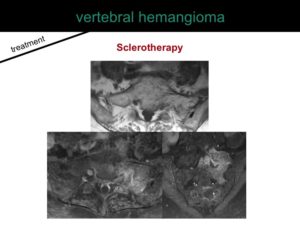 percutaneous ablation of benign bone tumors