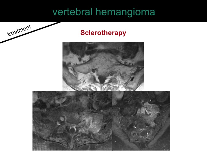 percutaneous ablation of benign bone tumors