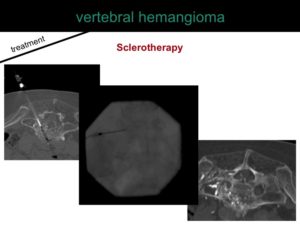 percutaneous ablation of benign bone tumors