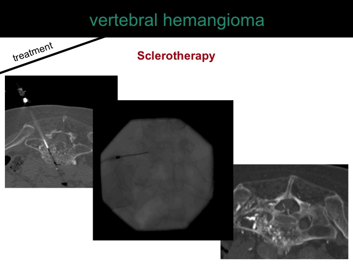 percutaneous ablation of benign bone tumors