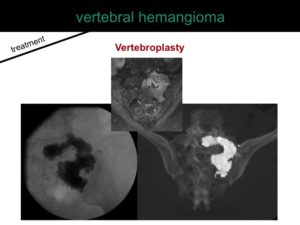 percutaneous ablation of benign bone tumors