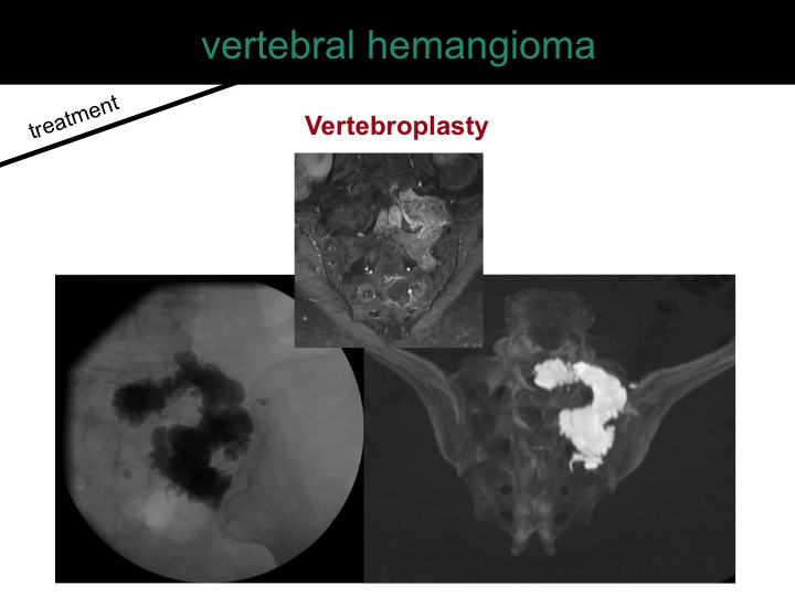 percutaneous ablation of benign bone tumors