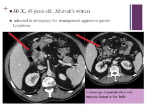 Vascular oncology emergencies managementHemorrhage in oncologic interventional radiology
