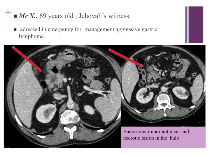 Vascular oncology emergencies managementHemorrhage in oncologic interventional radiology