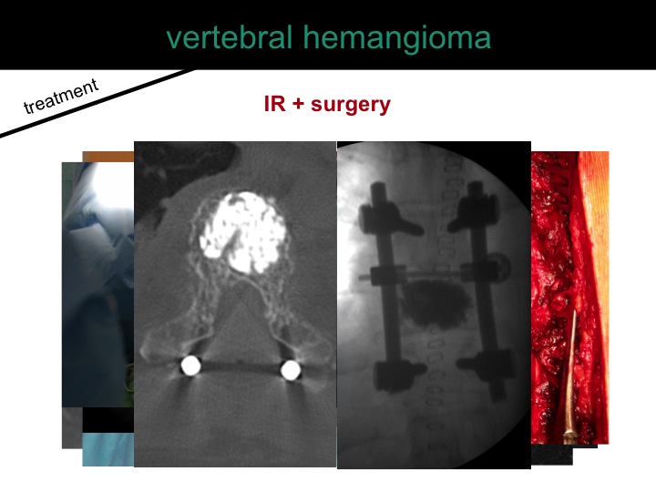percutaneous ablation of benign bone tumors