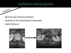 percutaneous ablation of benign bone tumors