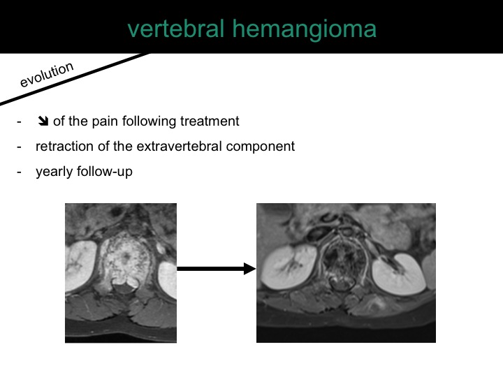 percutaneous ablation of benign bone tumors