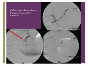 Vascular oncology emergencies managementHemorrhage in oncologic interventional radiology