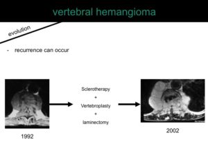 percutaneous ablation of benign bone tumors
