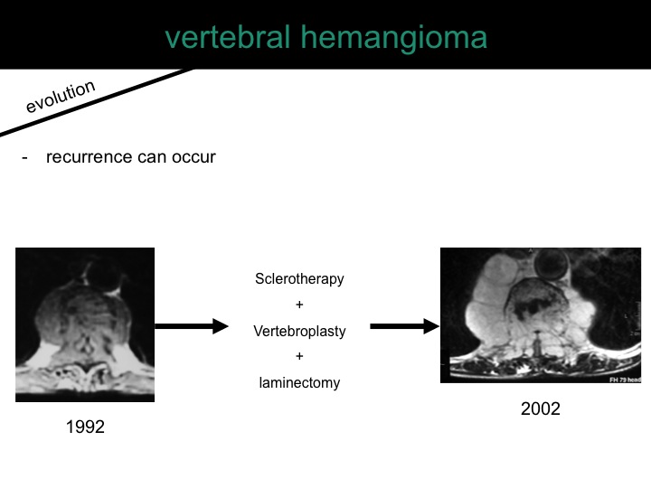 percutaneous ablation of benign bone tumors