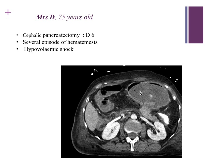 Vascular oncology emergencies managementHemorrhage in oncologic interventional radiology