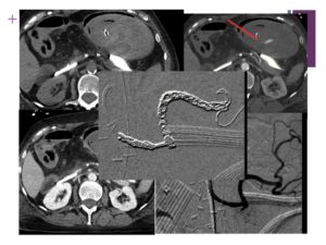 Vascular oncology emergencies managementHemorrhage in oncologic interventional radiology