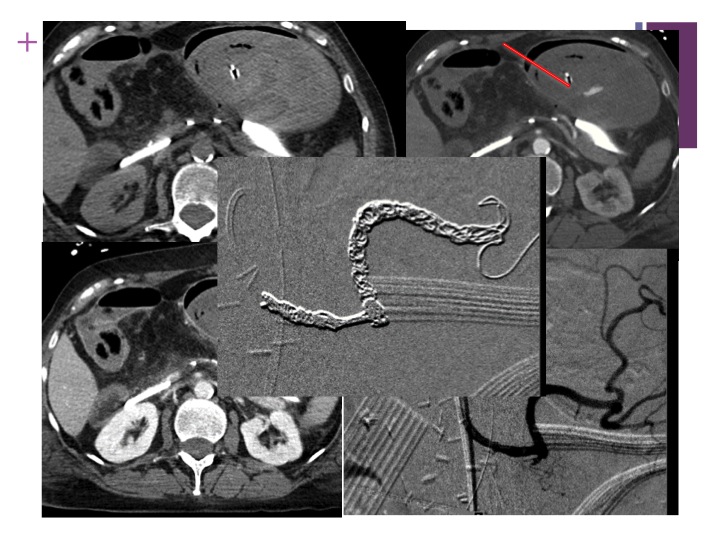Vascular oncology emergencies managementHemorrhage in oncologic interventional radiology