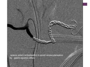 Vascular oncology emergencies managementHemorrhage in oncologic interventional radiology