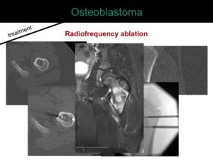 percutaneous ablation of benign bone tumors