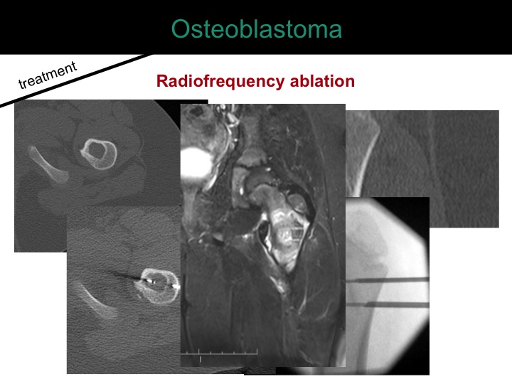 percutaneous ablation of benign bone tumors