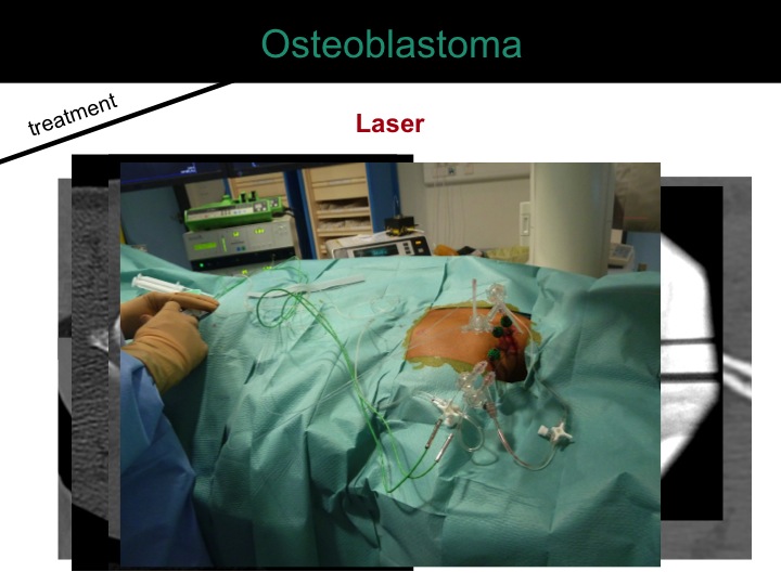 percutaneous ablation of benign bone tumors