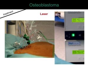 percutaneous ablation of benign bone tumors