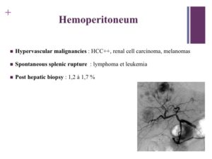 Vascular oncology emergencies managementHemorrhage in oncologic interventional radiology