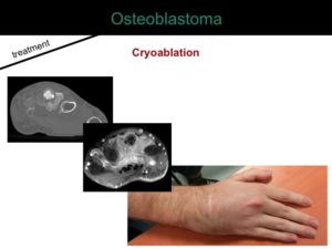 percutaneous ablation of benign bone tumors