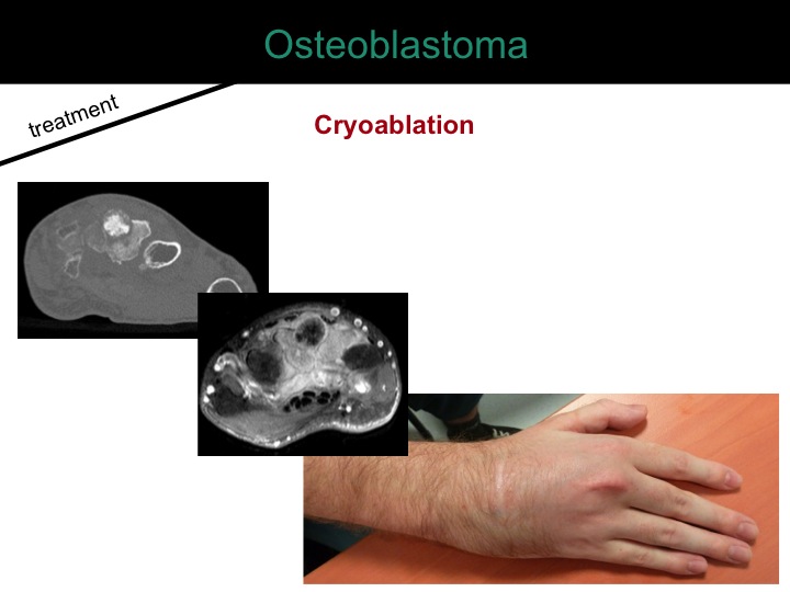 percutaneous ablation of benign bone tumors