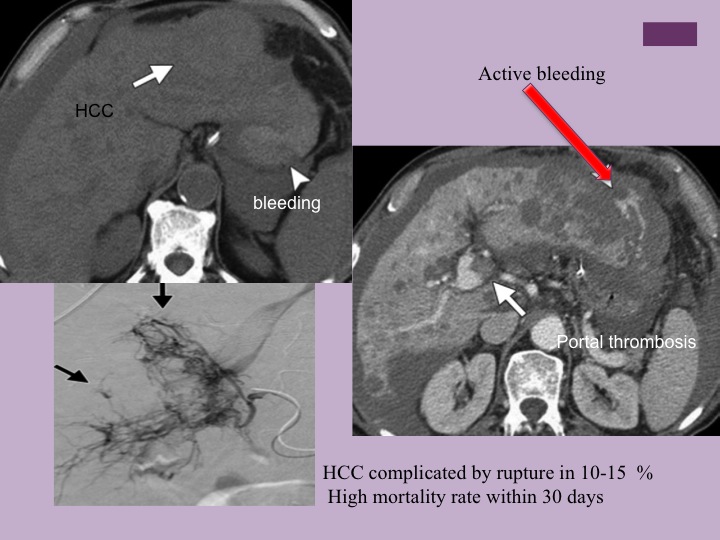 Vascular oncology emergencies managementHemorrhage in oncologic interventional radiology