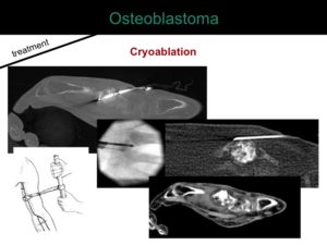 percutaneous ablation of benign bone tumors